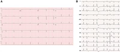 Case Report: Electroanatomic mapping as an early diagnostic tool in arrhythmogenic cardiomyopathy